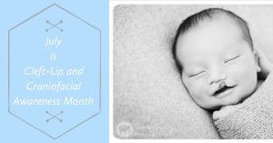 Sleepy baby with a cleft lip next to blue box with "Cleft-Lip Craniofacial Awareness Month" text